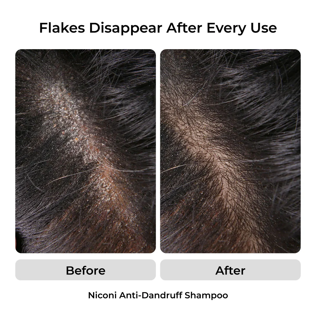 The Anti-Dandruff Hair Revival Combo - Image 4